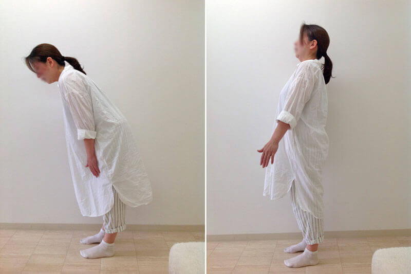 ぎっくり腰レッドコード矯正前